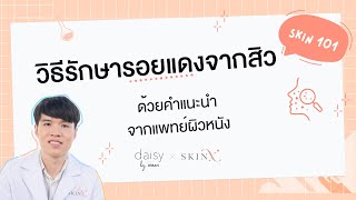 วิธีรักษารอยแดงจากสิว ทำยังไงให้หาย | Jeban x SkinX