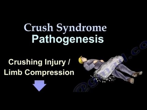 Crush Syndrome, Earthquake Injuries. Crush Syndrome Symptoms, Diagnosis ...