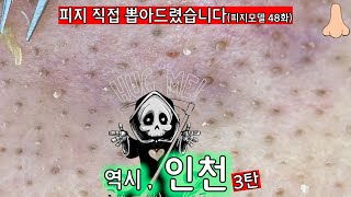 피지 직접 뽑아드렸습니다 _  인천 피지대왕을 접하다! 이로써 인천은 이 모델분 아래 모두 평등할것이다 3탄