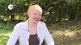 Miss Albinism East Africa