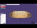 Lower anterior designing in Exocad elefsina