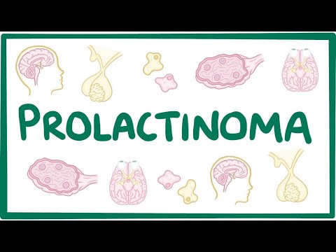 Can hypothyroidism cause Prolactinoma?