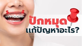 ปักหมุด เเก้ปัญหายิ้มเห็นเหงือกได้ยังไง⁉️ I หมอฟัน SmileBox