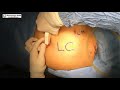 skin to skin laparoscopic cholecystectomy in 4k