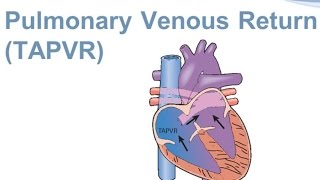 Total Anomalous Pulmonary Venous Return (TAPVR)