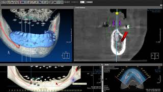 Full Edentulous Mandible Implant Placement