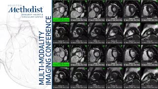 Multi-Modality Case Presentations: by Advanced CV Imaging Fellows (Dipan J. Shah, MD) June 1, 2021