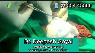 Frenuloplasty: Tight Frenulum or Frenular Tear Repair Surgery Painless Experience - Dr Deepesh Goyal