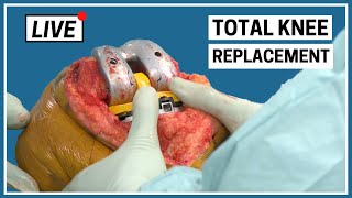 LIVE - Total Knee Replacement Surgery by Knee Expert