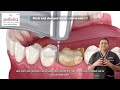 black and decayed teeth what you need to know tooth decay cavities dental caries