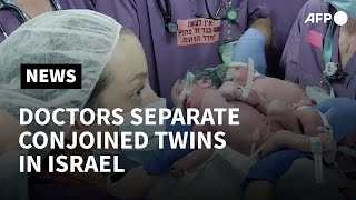 Doctors separate 1-year-old conjoined twins for first time in Israel | AFP