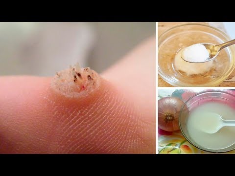 How to Get Rid of Warts Naturally How to Get Rid of Warts Naturally
