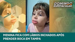 Menina de 5 anos fica com os lábios inchados após prender a boca em tampa | Domingo Espetacular