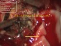 HAEMANGIOBLASTOMA CEREBELLUM  microsurgery-dr suresh dugani/HUBLI/KARNATAK/INDIA