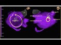 ECG and 3D map of atypical atrial tachycardia