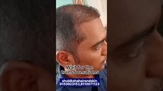 Ht பண்ண இவளோ ஹெர் குரௌத் ஆகுமா😱🤔😳 watch till the end #hairtransplantclinic #prp #gfc#skinwhitening