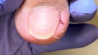 The ingrown toenail on one side is extremely curved and carefully trimmed