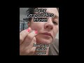 Trying Seranova Micro infusion for the first time 