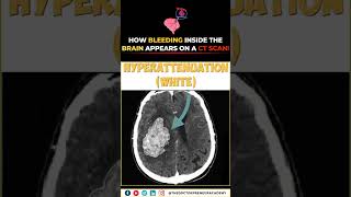 🔍 How Brain Bleeding Appears on a CT Scan | Intracerebral Hemorrhage Explained 🧠🩸