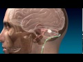 Deep Brain Stimulation for Stroke Recovery Animation