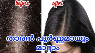 Dandruff/താരൻ പൂർണ്ണമായും മാറ്റാൻ ഇത്പോലൊന്ന് ചെയ്തു നോക്കു 100% Result/home remedies for dandruff