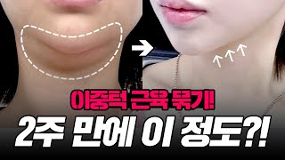 이중턱 지방흡입+근육묶기 대박난 케이스 리뷰 #이중턱제거