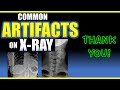 common artifacts on x ray radiology xray doctor