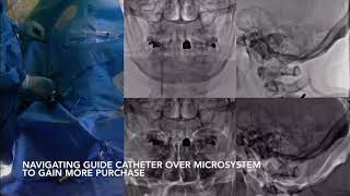 Deployment of distal posterior cerebral artery flow diverter in tortuous anatomy