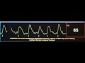 cardiac mri peripheral waveform