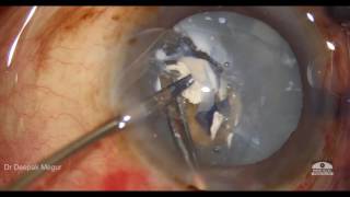 Managing a calcifed capsule in a hypermature cataract