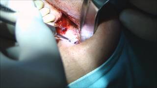 Sinus Lift Bilateral com PRF e Lumina Porous - BILATERAL SINUS LIFTING WITH PLATELET-RICH FIBRIN