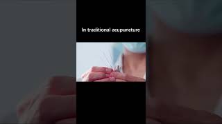 The Differences Between Traditional Acupuncture and Microcurrent Electrical Acupuncture （part 1)