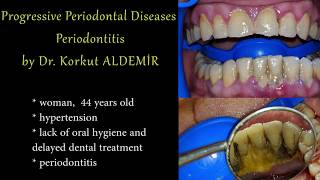 Periodontal Diseases Periodontitis