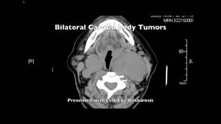 Adjunctive Techniques for Large Carotid Body Tumors: Percutaneous Embolization and TCD Monitoring