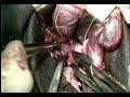 Пластика пахового канала по методу Шоулдайса © plastic inguinal canal on shouldaysa method