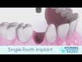 demo how do single tooth implants work