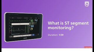 What is ST segments monitoring?