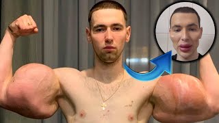 His Fake Muscles Exploded: The Russian Synthol Kid Is Back!