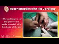 ear reconstruction surgery with the patient s own rib cartilage designer bodyz dr. parag telang