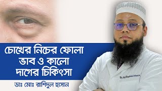 চোখের নিচে কালো দাগ ও ফোলা ভাব - Under eye dark circles treatment -