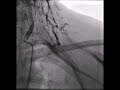 subclavian steal syndrome