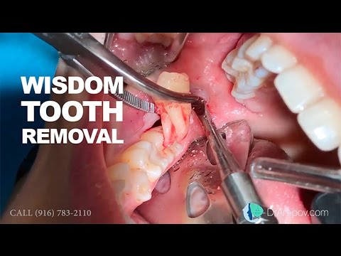 Wisdom Tooth Removal In 5 MIN Or Less. Surgical Guide: Online Course ...