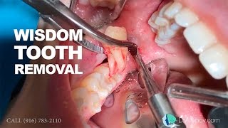 Wisdom tooth removal in 5 MIN or less. Surgical Guide: Online Course + Free e-Bo