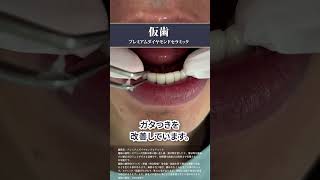 仮歯でこんなに綺麗に‼️上下10本を仮歯に🦷✨プレミアムダイヤモンドセラミックプラン