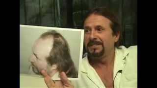 Hair Loss Treatment | Hair Transplant by Alba Reyes MD to a patients that came to DR from California