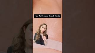 Effective Stretch Mark Creams - Bye Bye Stretch Marks!