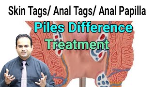 Skin Tags | Anal Tags | Anal Papilla|Piles|Moky | Difference & Treatment | Surgeon Dr Imtiaz Hussain