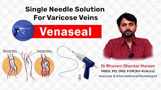 Glue therapy varicose veins