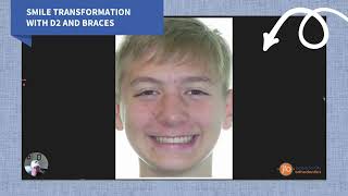 Smile Transformation Using D2 Appliance \u0026 Braces | Joosse Family Orthodontics | Williamsburg, VA