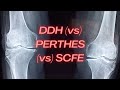 Developmental dysplasia of hip (DDH), Perthes disease and Slipped capital femoral epiphysis (SCFE)